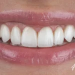 The Different Types Of Veneers