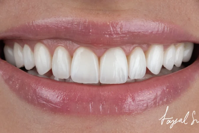 The Different Types Of Veneers