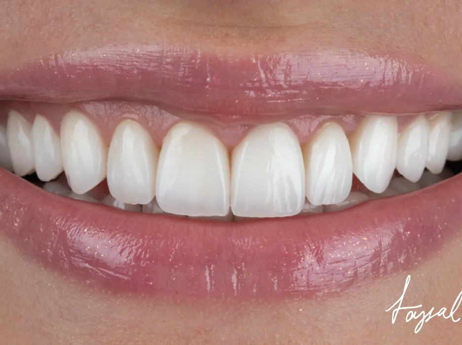 The Different Types Of Veneers